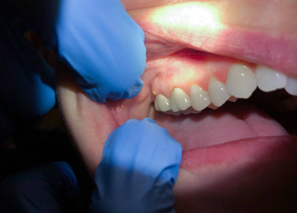 Best Dental Abscess Treatment in Parker, AZ